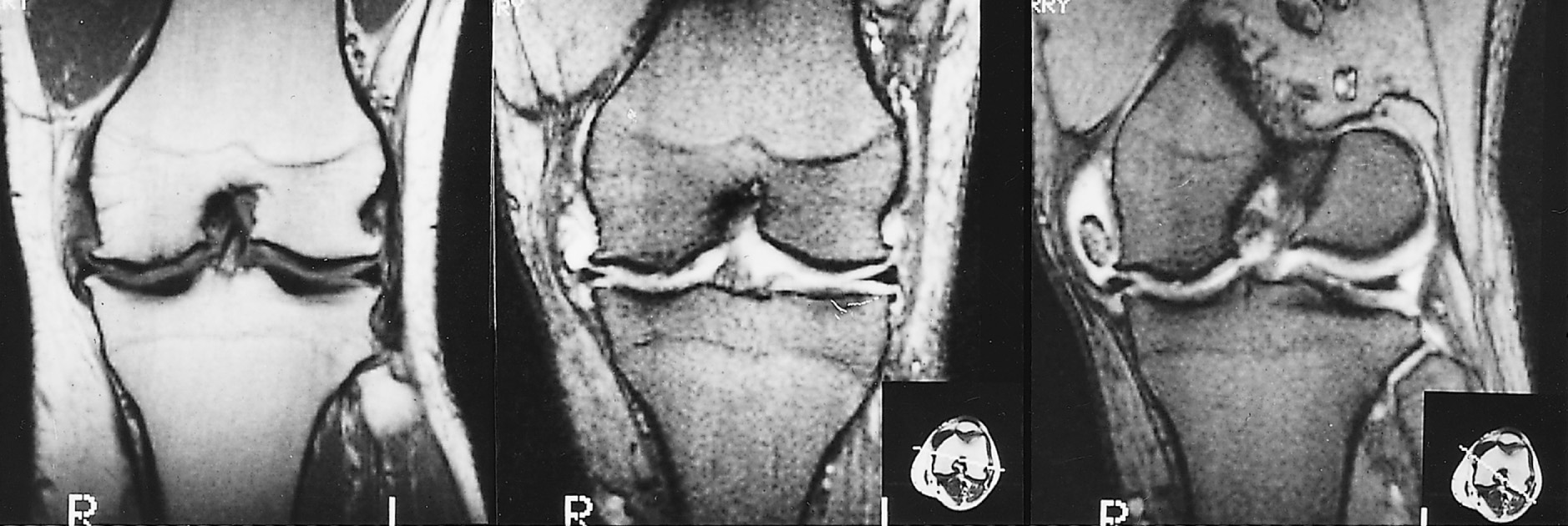 Osteoarthritis. MRI demonstrates degenerative changes of the knee with an effusion, loss of the medial meniscus, marginal osteophytosis and a large loose body lying medially within the joint. †