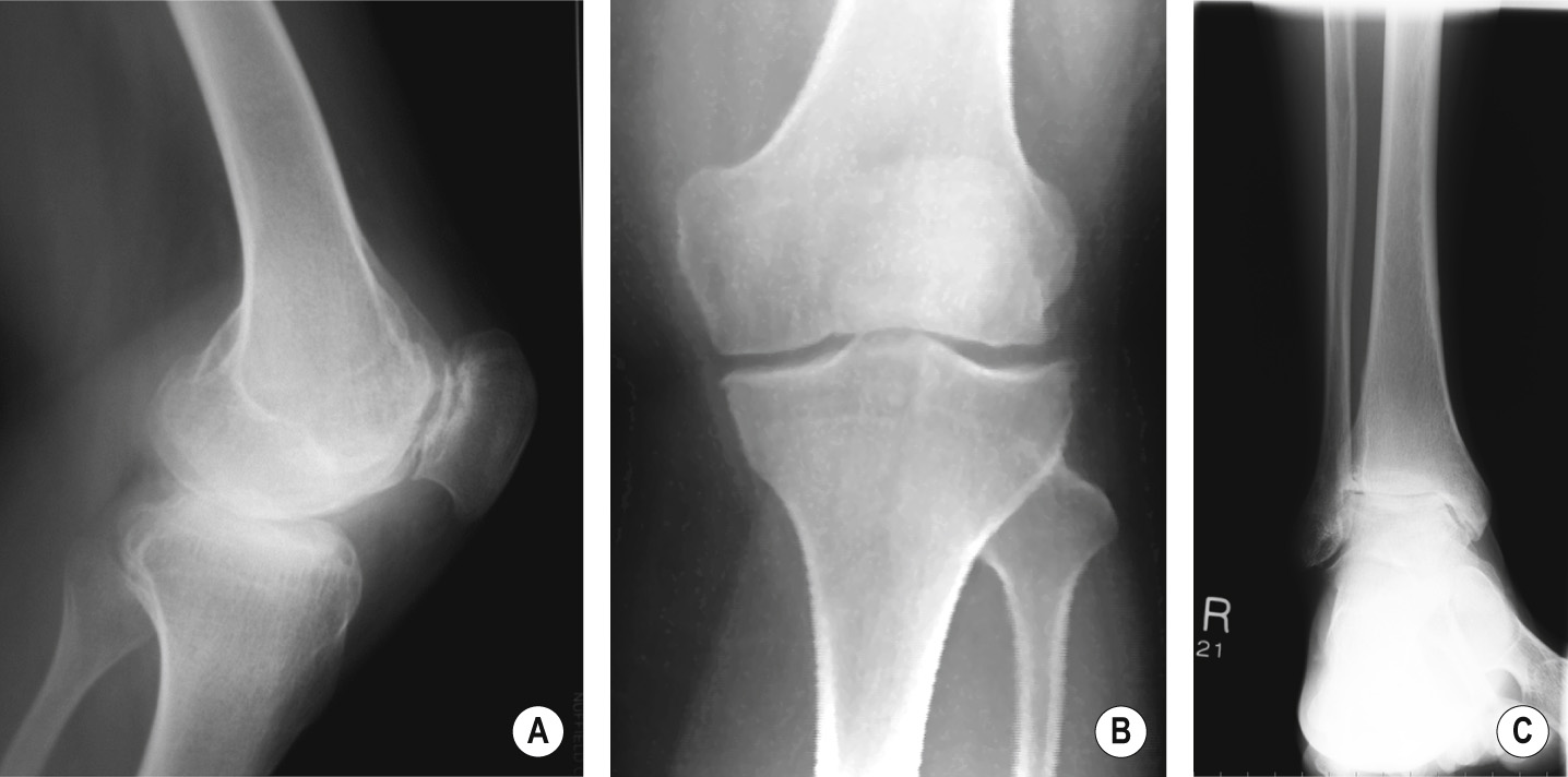Classic radiographic findings in hemophilia. (A) Note squaring of inferior pole of the patella. (B) Enlarged femoral condyles. (C) Tibiotalar slant. ©35