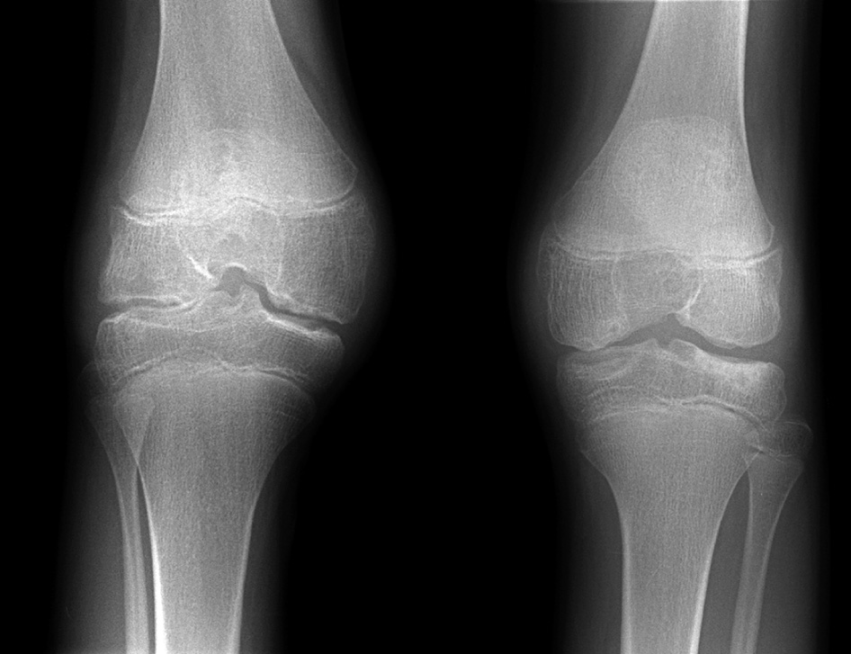 Bleeding into the joints in haemophilia. AP XR demonstrating widened intercondylar notches, narrow joint spaces and erosive change. The right knee is more severely affected. *