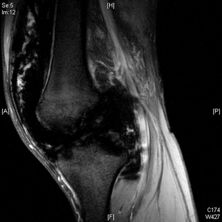 Gradient echo (GE) MR images of the knee in a patient with advanced haemophilia. There is low signal abnormality in the synovium, secondary to hemosiderin deposition. GE images are the most sensitive to susceptibility, and this can be seen in the marked ‘blooming’ artefact. ©35