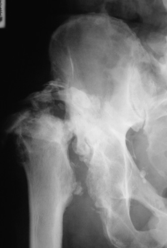 Syphilitic neuropathic arthropathy of the hip. There is destruction and fragmentation of the right femoral head leading to bony dislocation and joint disorganization. *