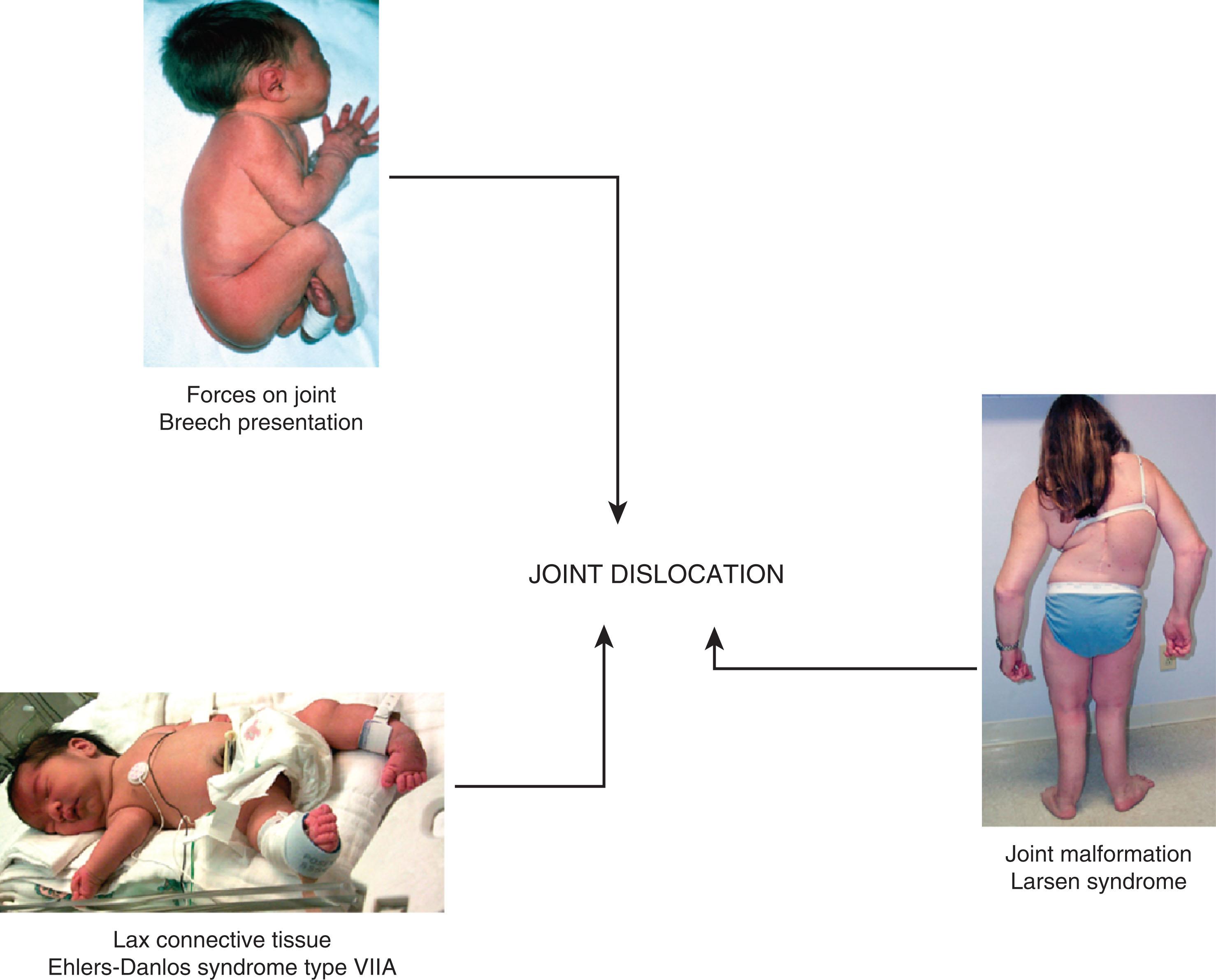 Genetic Dislocation Joint Dislocation - Clinical Tree