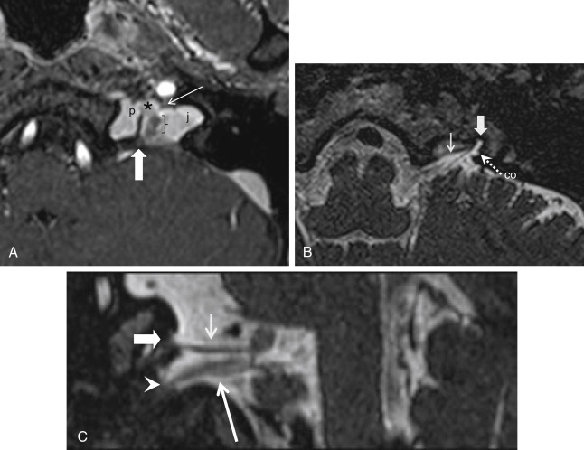 Fig. 13.2, Jugular Foramen Anatomy on MRI.