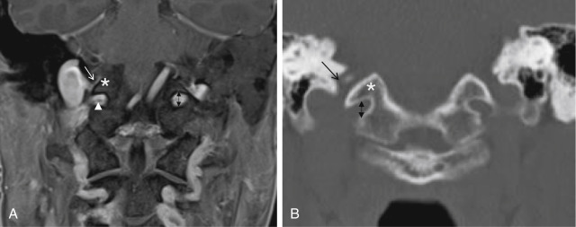 Fig. 13.3, Imaging of the Jugular Foramen and Hypoglossal Canal.