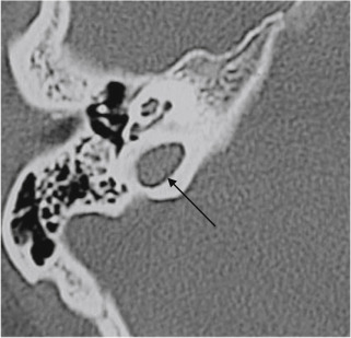 Fig. 13.4, Normal Variant: High-Riding Jugular Bulb.