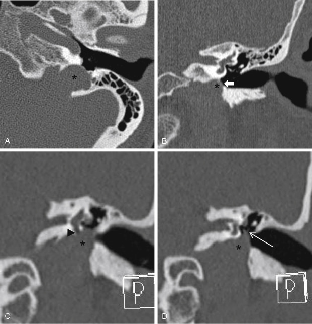 Fig. 13.5, Normal Variant: Jugular Bulb Dehiscence in Two Patients.