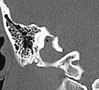 Fig. 13.6, Normal Variant: Jugular Bulb Diverticulum.