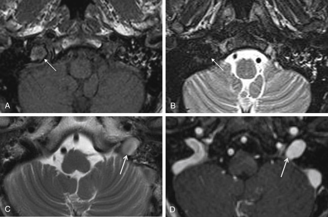 Fig. 13.7, Jugular Bulb Pseudolesion in Two Patients.