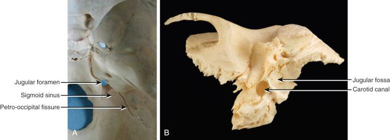 Figure 49.1, Intracranial (A) and extracranial (B) views of the jugular foramen and fossa. From the intracranial view, the groove produced by the sigmoid sinus can be seen flowing into the superior aspect of the jugular foramen and its close proximity to the internal auditory canal above the hypoglossal canal medially. The extracranial view shows its very close relationship to the external opening of the carotid canal.