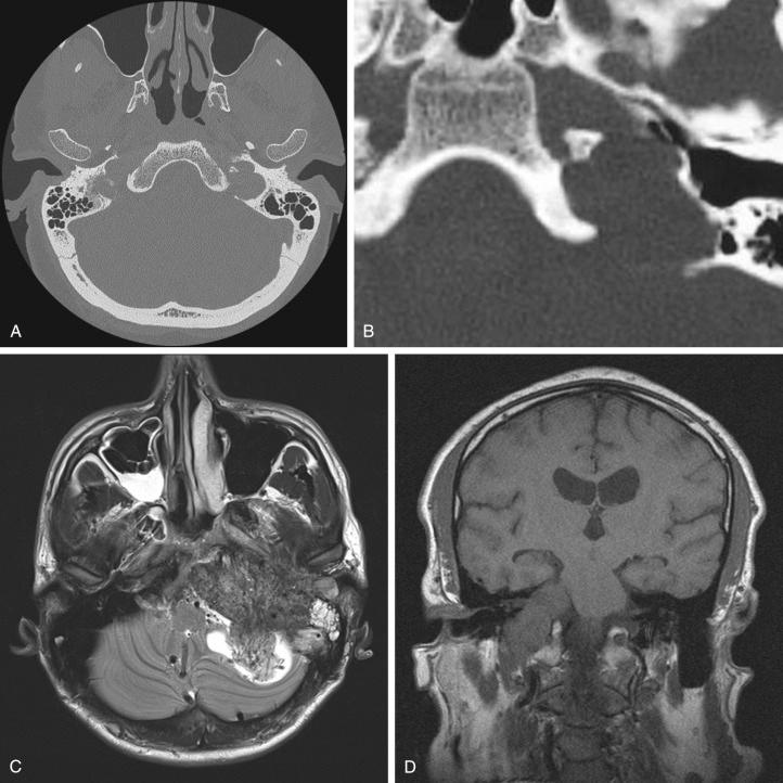 Figure 49.2, (A) Axial CT showing the moth-eaten appearance around the right jugular foramen produced by a jugular paraganglioma. (B) Axial CT showing a well-corticated but scalloped jugular foramen produced by a vagal schwannoma. (C) Axial T 2 MRI showing a very large jugular paraganglioma which contains numerous flow voids. (D) Coronal T 1 MRI of a dumbbell vagal schwannoma, with an isointense signal to the brain parenchyma that moulds the brainstem.