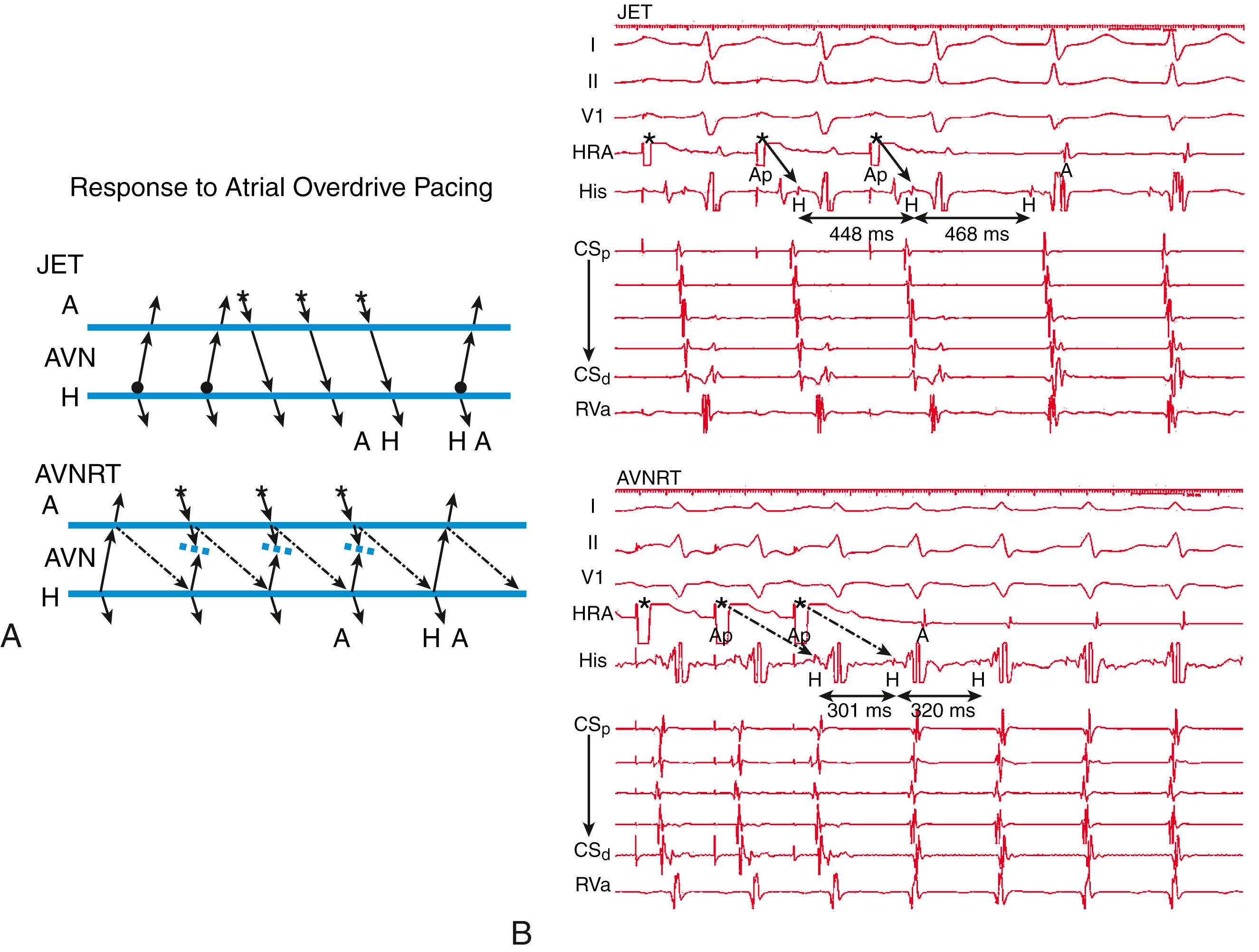 Fig. 73.1, Atrial overdrive pacing to differentiate junctional ectopic tachycardia (JET) from atrioventricular nodal reentrant tachycardia (AVNRT).