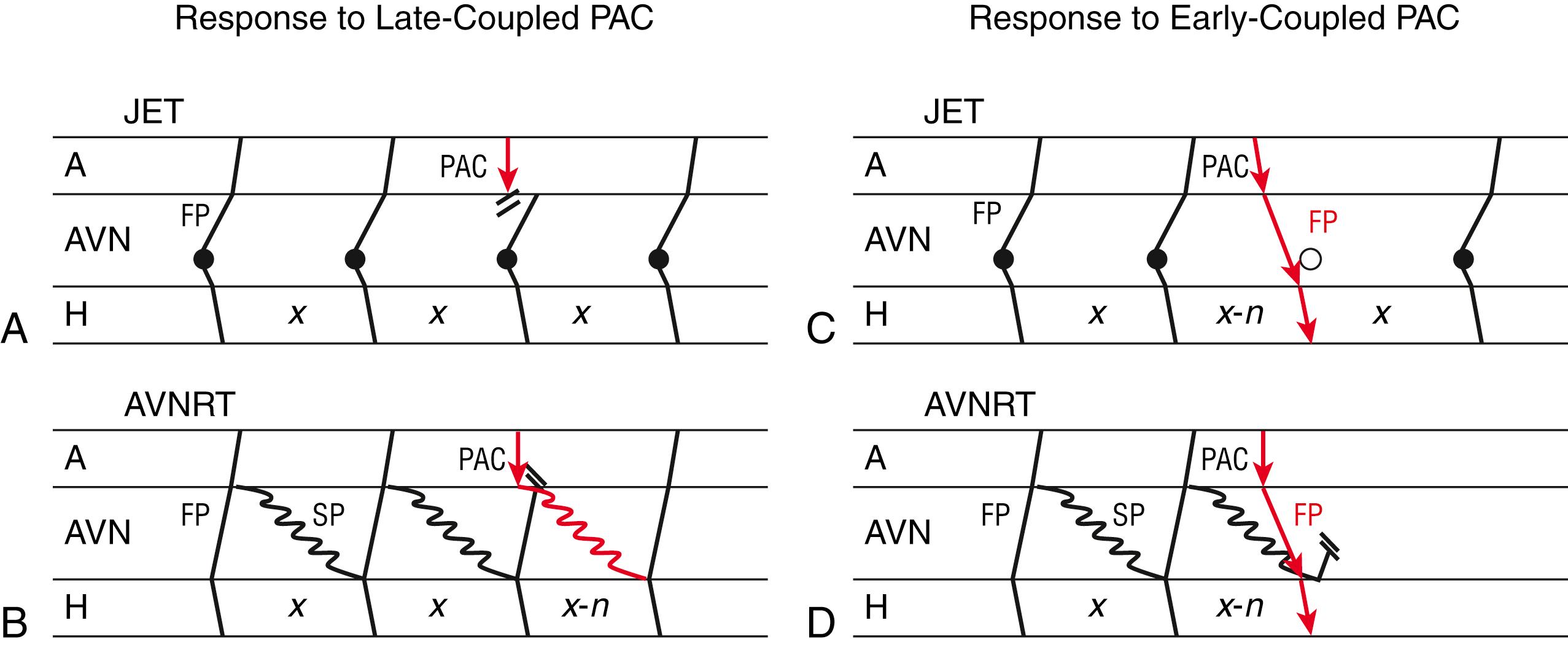 Fig. 73.2, Premature atrial contraction (PAC) response to differentiate junctional ectopic tachycardia (JET) from atrioventricular nodal reentrant tachycardia (AVNRT).