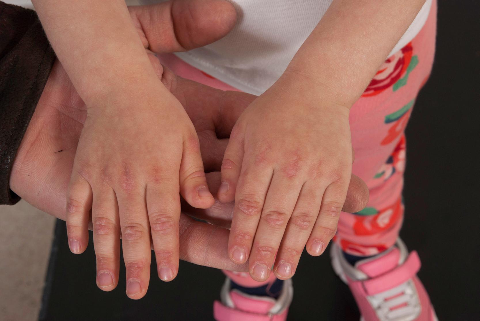 Fig. 26.3, Gottron papules over metacarpophalangeal and interphalangeal joints.