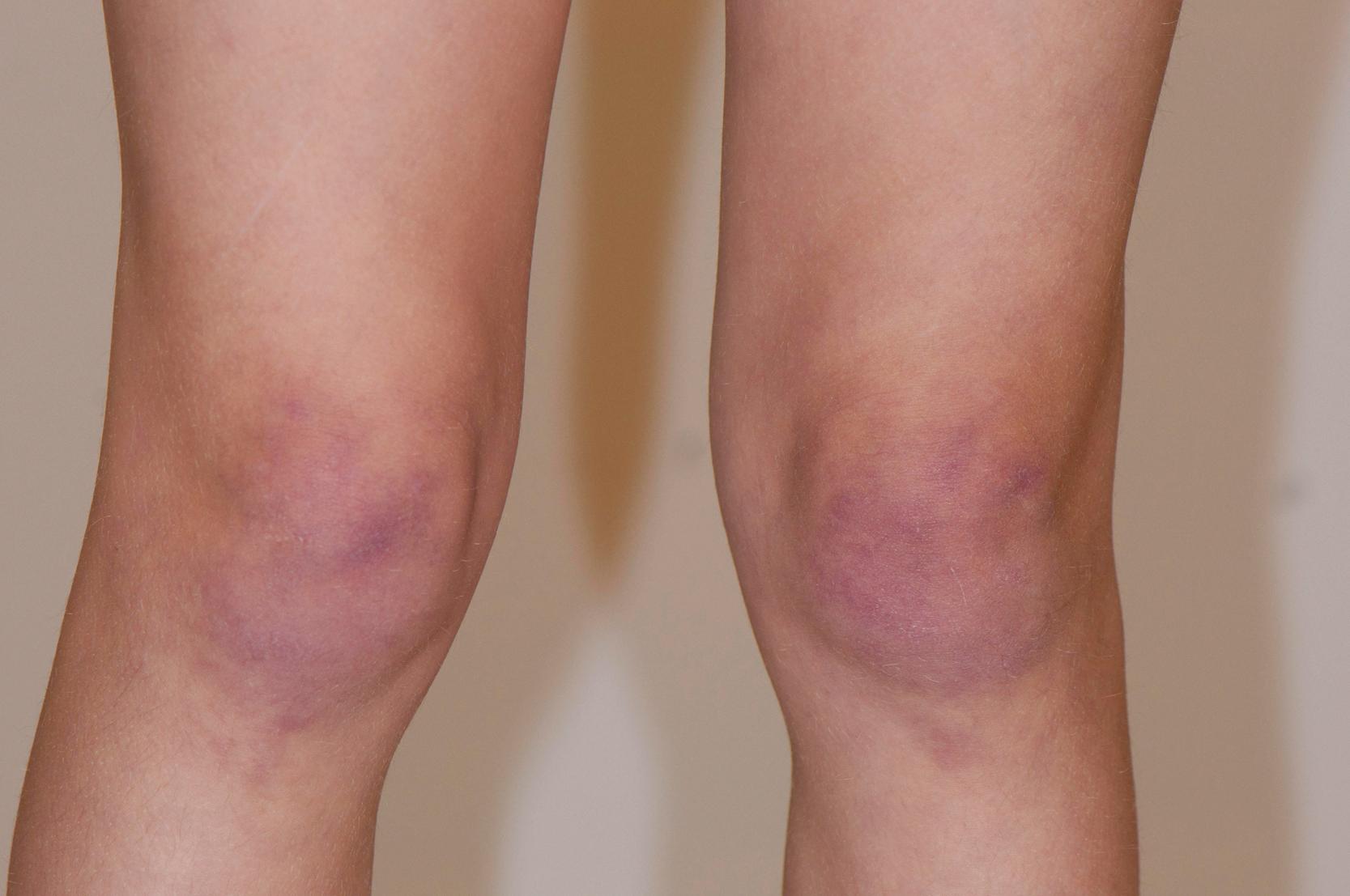 Fig. 26.4, Gottron papules over the knees.