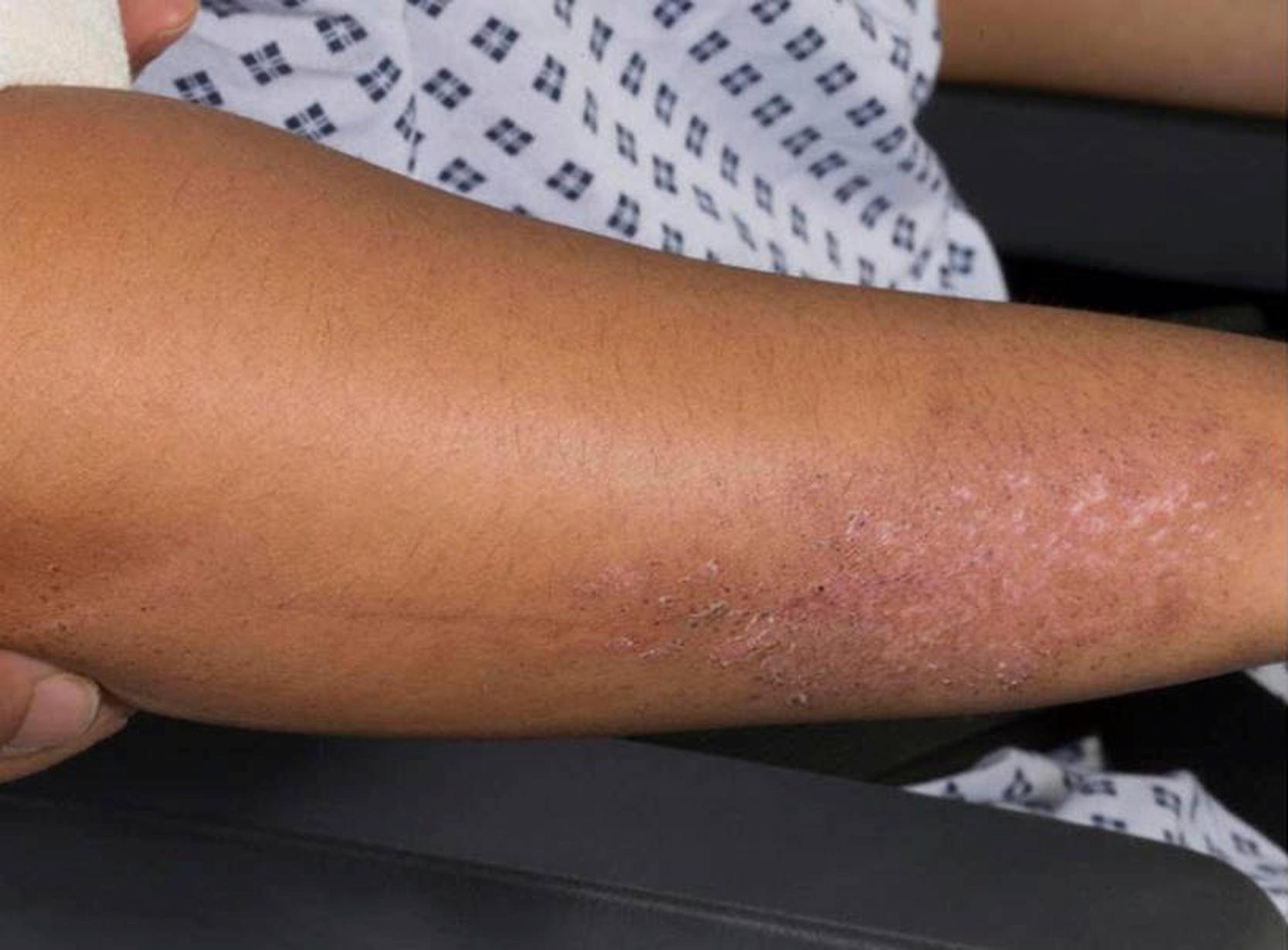 Fig. 26.6, Skin ulceration on forearm.