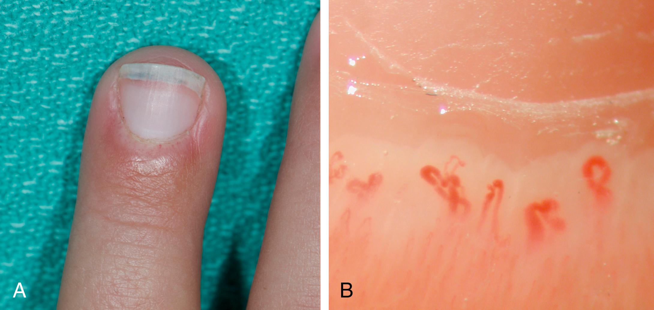 Fig. 26.7, A, Abnormal nailfold capillary pattern with the classic changes of dermatomyositis. B, capillary dropout and enlarged and tortuous capillaries.