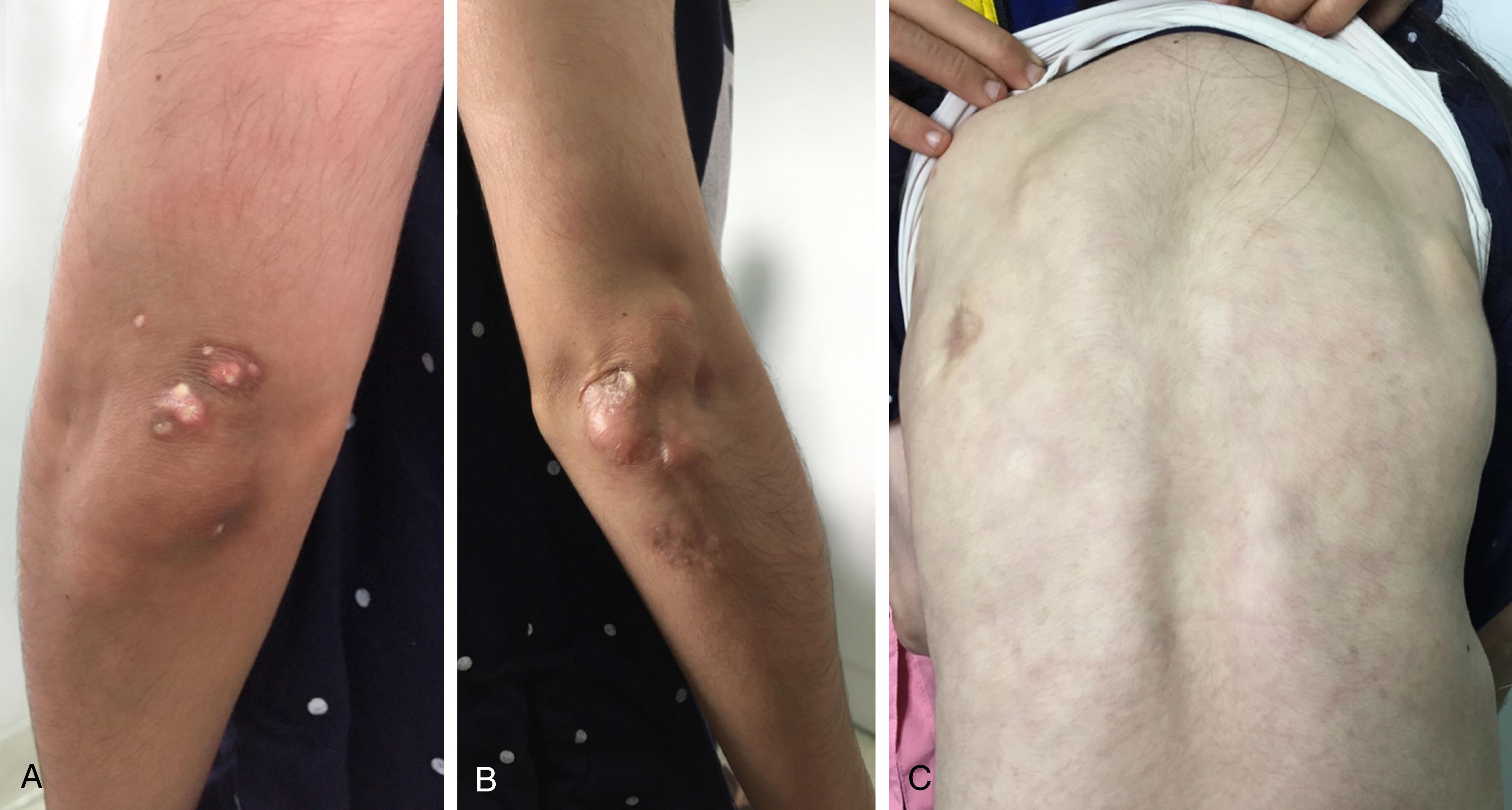 Fig. 26.8, A, (and B ) Calcinosis over the elbows, resulting in a flexion contracture. C, Calcinosis overlying the back in the same child.