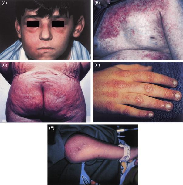 Figure 42.1, Cutaneous features of juvenile dermatomyositis. ( A ) The rash of JDM showing the periorbital edema, erythema crossing the bridge of the nose, and swelling of the right cheek. ( B ) Severe diffuse involvement with poikilodermatous changes on the chest. ( C ) Rash over the buttocks can be painful, making sitting uncomfortable. ( D ) The hands of an adolescent with JDM showing severe Gottron’s papules, periungual thickening, and dilated nailfold capillary loops. ( E ) Inflammation and secondary infection of an area of dystrophic calcification in a newly diagnosed child with JDM.