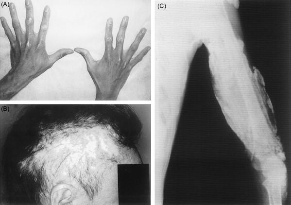 Figure 42.5, Features of chronic long-standing disease in JDM. ( A ) Lipoatrophy showing loss of fat over hand/fingers. ( B ) Scarring of the scalp following chronic inflammation with extensive hair loss. ( C ) Extension of pathological calcifications as seen on radiograph of the arm of a child with long-standing active disease.