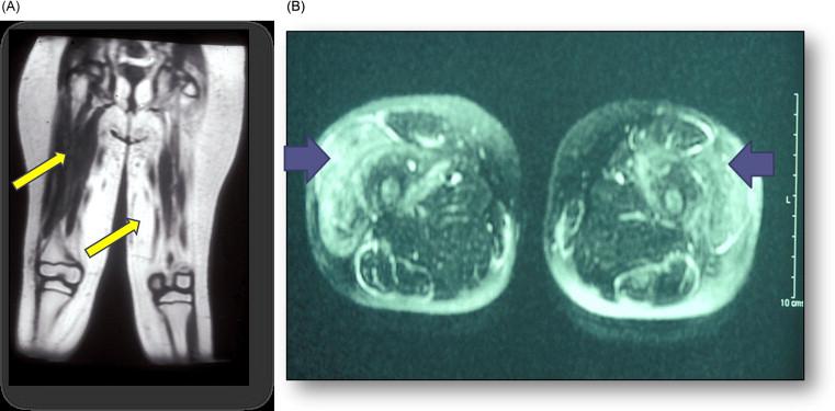 Figure 42.6, ( A ) Sagittal view of the MRI of a child positive for U1-RNP. The regions of muscle inflammation (white areas) are asymmetrical; the undirected biopsy of an area subsequently found not to be involved was read as “normal.” The MRI directed biopsy (white area) showed characteristic inflammation and muscle fiber damage. ( B ) Magnetic resonance image of a child with early symptoms of JDM and normal muscle enzymes. This T2 weighted image displays the patchy nature of the muscular involvement: the white areas (arrows) show the symmetrical edema of active inflammation surrounded by thickened fascia.