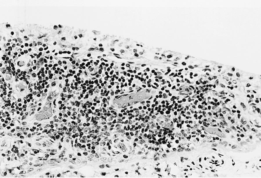 Fig. 180.1, Synovial biopsy specimen from a 10 yr old child with oligoarticular juvenile idiopathic arthritis. There is a dense infiltration of lymphocytes and plasma cells in the synovium.