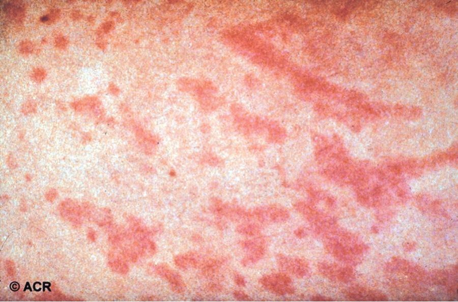 Fig. 180.12, The rash of systemic juvenile idiopathic arthritis is salmon-colored, macular, and nonpruritic. Individual lesions are transient and occur in crops over the trunk and extremities.