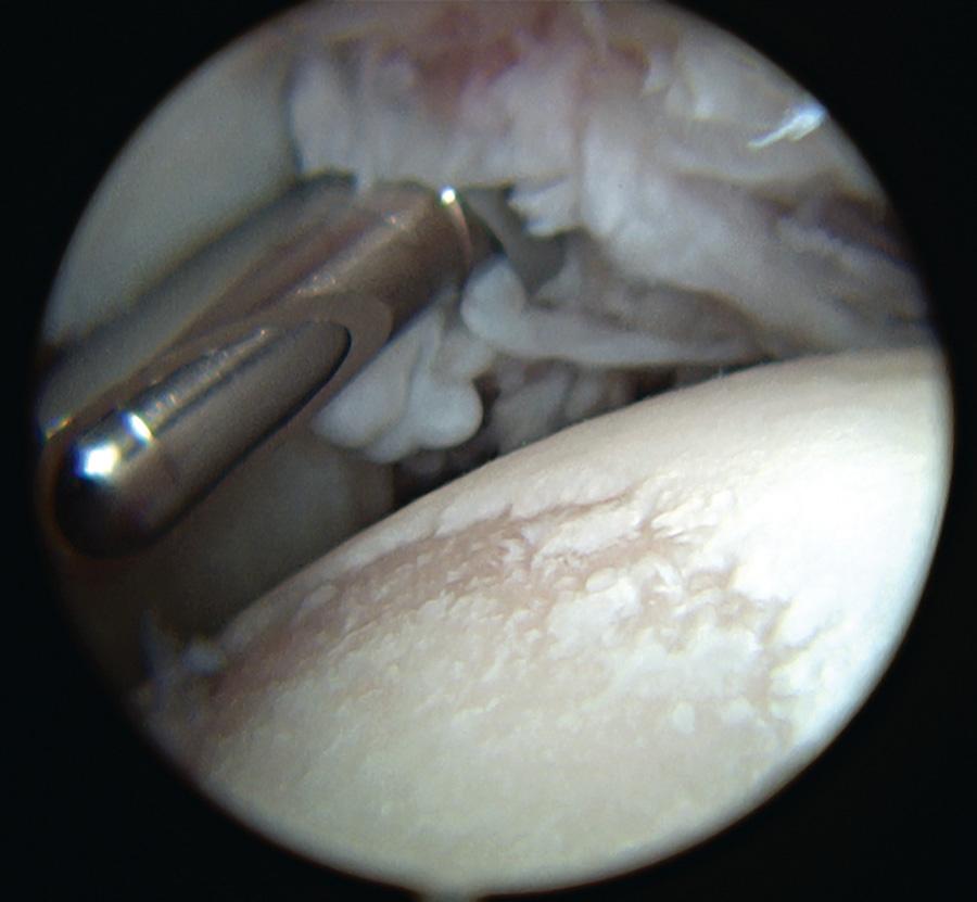 Fig. 180.2, Arthroscopy in the shoulder of a child with juvenile idiopathic arthritis showing pannus formation and cartilage erosions.
