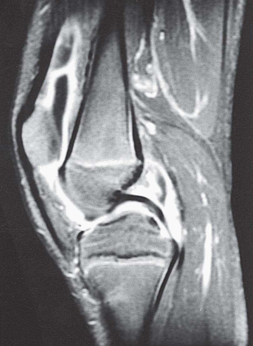 Fig. 180.3, MRI with gadolinium of a 10 yr old child with juvenile idiopathic arthritis (same patient as in Fig. 180.1 ). The dense white signal in the synovium near the distal femur, proximal tibia, and patella reflects inflammation. MRI of the knee is useful to exclude ligamentous injury, chondromalacia of the patella, and tumor.