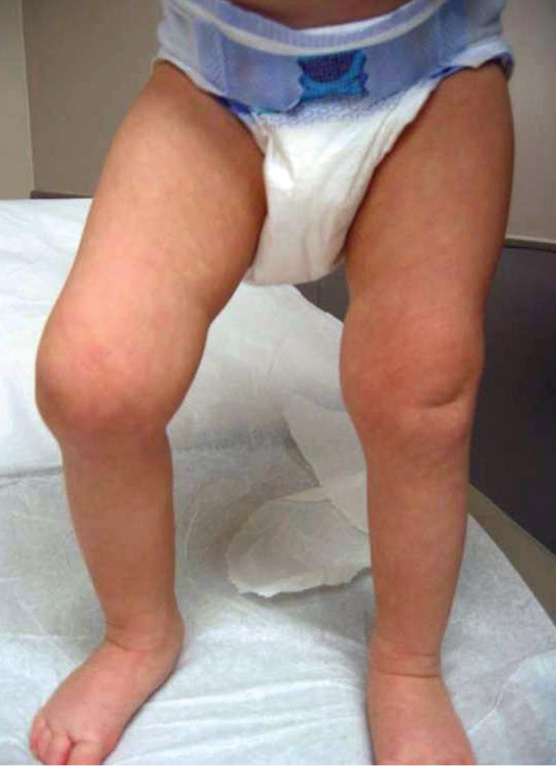 Fig. 180.4, Oligoarticular juvenile idiopathic arthritis with swelling and flexion contracture of the right knee.