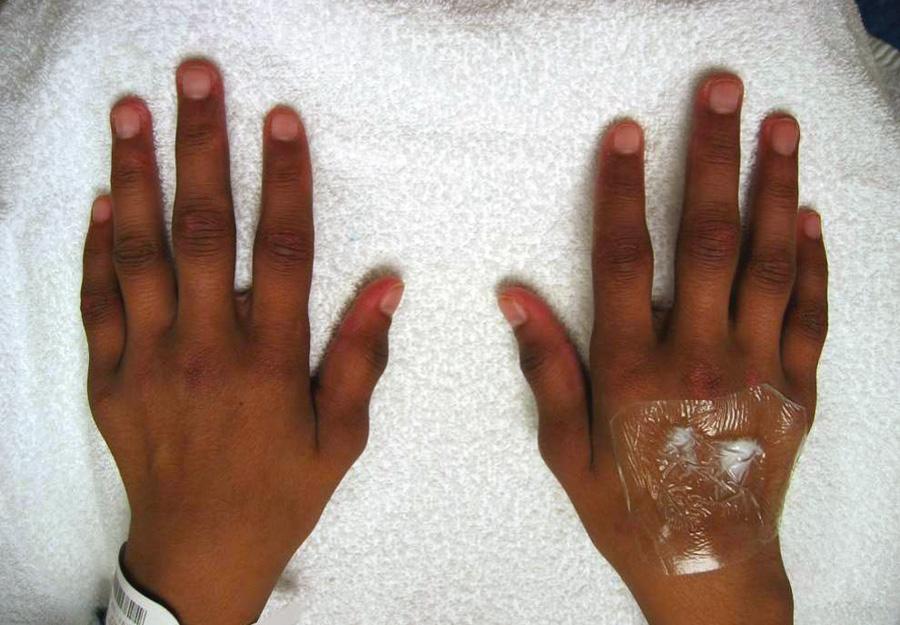 Fig. 180.5, Hands and wrists of a girl with polyarticular juvenile idiopathic arthritis, rheumatoid factor negative. Notice the symmetric involvement of the wrists, metacarpophalangeal joints, and proximal and distal interphalangeal joints. In this photograph, there is cream with occlusive dressing on the patient's right hand in preparation for placement of an intravenous line for administration of a biologic agent.