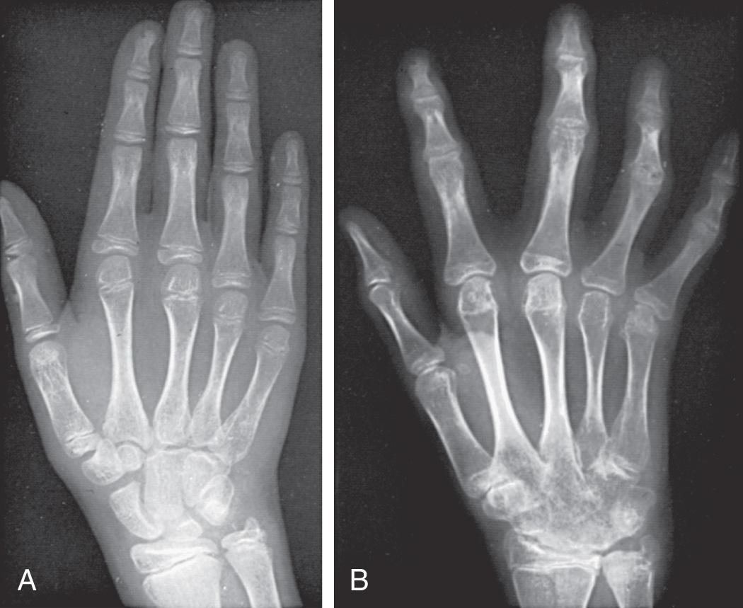 Fig. 180.6, Progression of joint destruction in a girl with polyarticular juvenile idiopathic arthritis, rheumatoid factor positive, despite doses of corticosteroids sufficient to suppress symptoms in the interval between the radiographs shown in A and B. A, Radiograph of the hand at onset. B, Radiograph taken 4 yr later, showing a loss of articular cartilage and destructive changes in the distal and proximal interphalangeal and metacarpophalangeal joints as well as destruction and fusion of wrist bones.