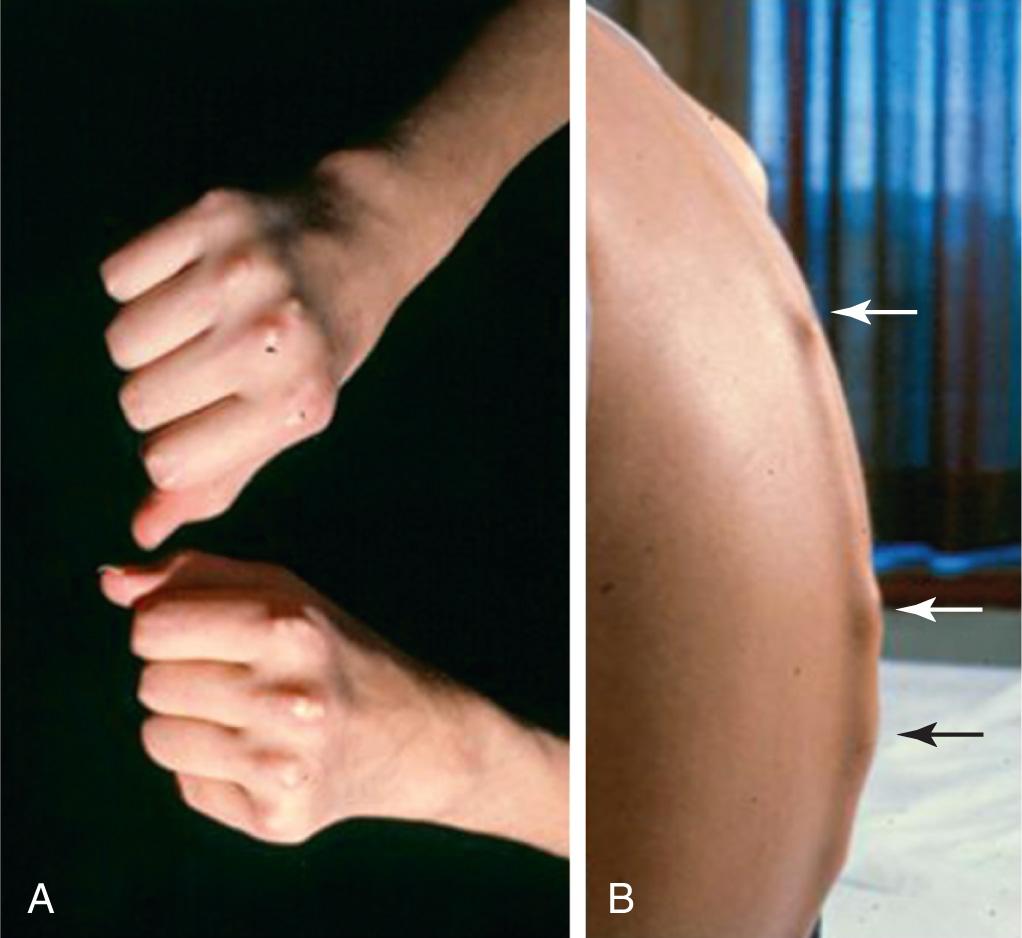 Fig. 180.7, Rheumatoid nodules overlying bony prominences in an adolescent with rheumatoid factor–positive polyarthritis.