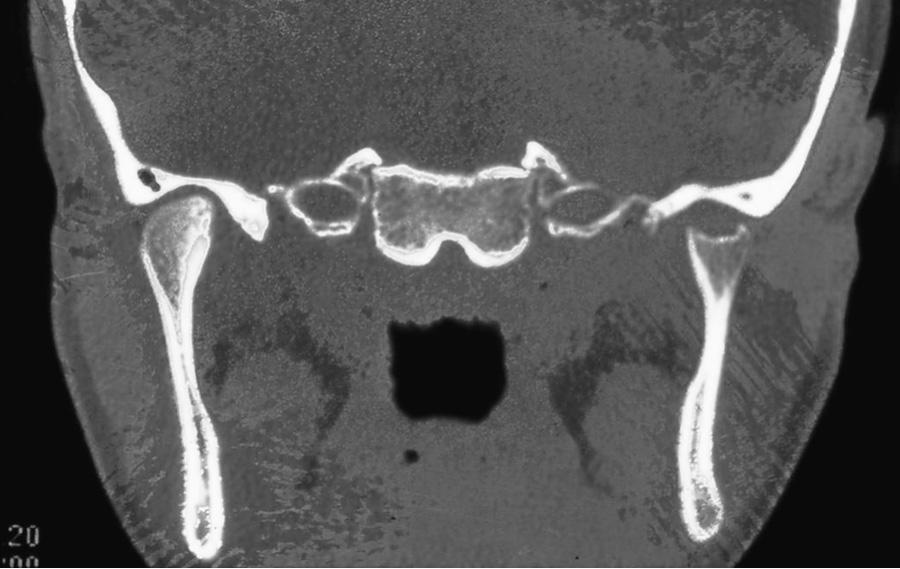 Fig. 180.8, CT scan of the temporomandibular joint of a patient with juvenile idiopathic arthritis exhibiting destruction on the right.