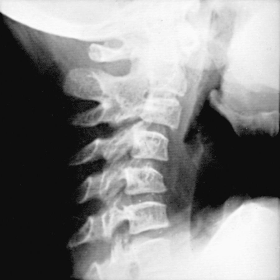 Fig. 180.9, Radiograph of the cervical spine of a patient with active juvenile idiopathic arthritis, showing fusion of the neural arch between joints C2 and C3, narrowing and erosion of the remaining neural arch joints, obliteration of the apophyseal space, and loss of the normal lordosis.