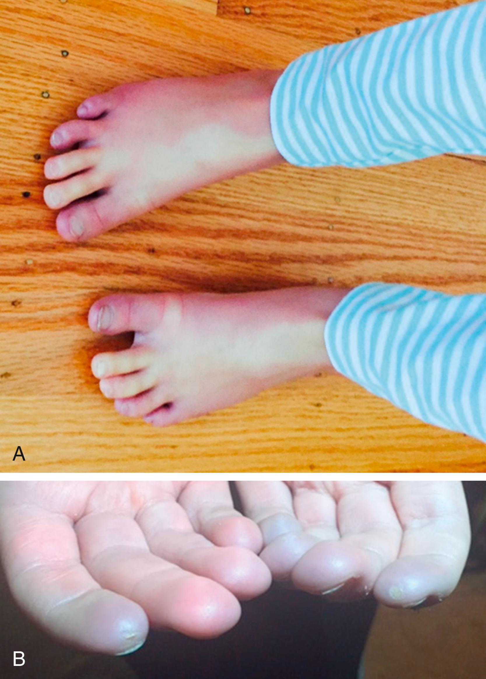 Fig. 27.10, Raynaud phenomenon in young children. A , A 2-year-old girl with cyanosis and pallor of her feet, who developed diffuse cutaneous systemic sclerosis at age 5. B , A 5-year-old boy with cyanosis and development of digital ulcers on index fingers.