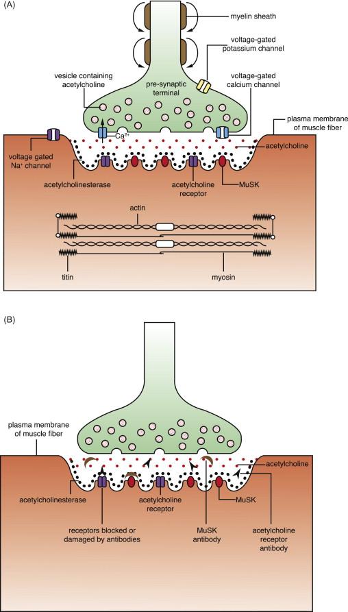 Figure 27.1, Schematic diagrams of ( A ), a normal neuromuscular junction illustrating locations of the presynaptic vesicles, acetylcholine within the synapse, and the postsynaptic acetylcholine receptors, as well as ( B ), a neuromuscular junction affected by myasthenia gravis, with antibodies that interfere with the binding and/or structure of the acetylcholine receptors and muscle-specific kinase (MuSK) (note that antibodies to both proteins are not typically present in the same individual, though this phenomenon has been reported on occasion).