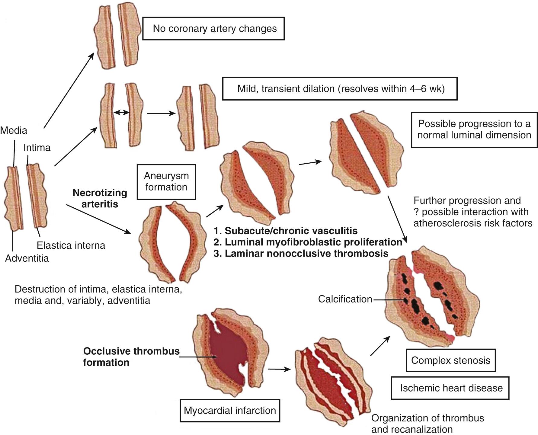 Fig. 191.1, Natural history of coronary artery abnormalities.