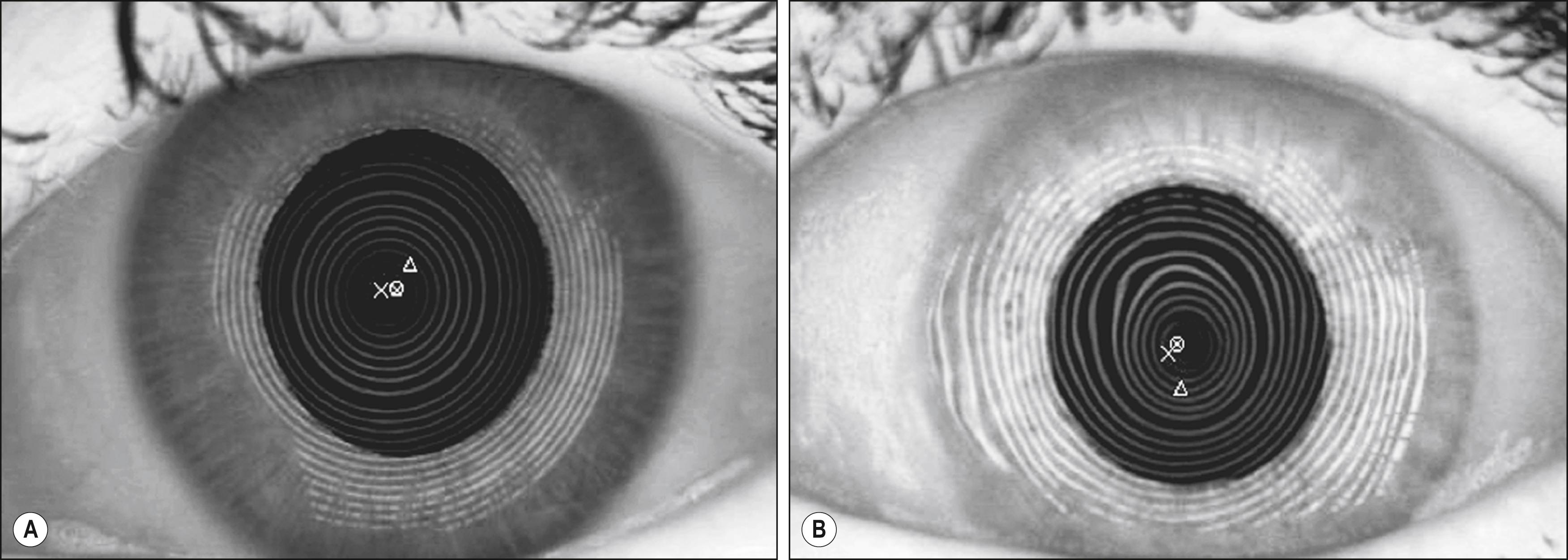 Fig. 11.2, Placido disk-based topography with normal ( A ) and irregular ( B ) Placido rings. Evenly spaced rings are seen in the normal cornea with minimal astigmatism. The irregular rings show central flattening and inferior steepening with rings spaced further apart and closer together, respectively.