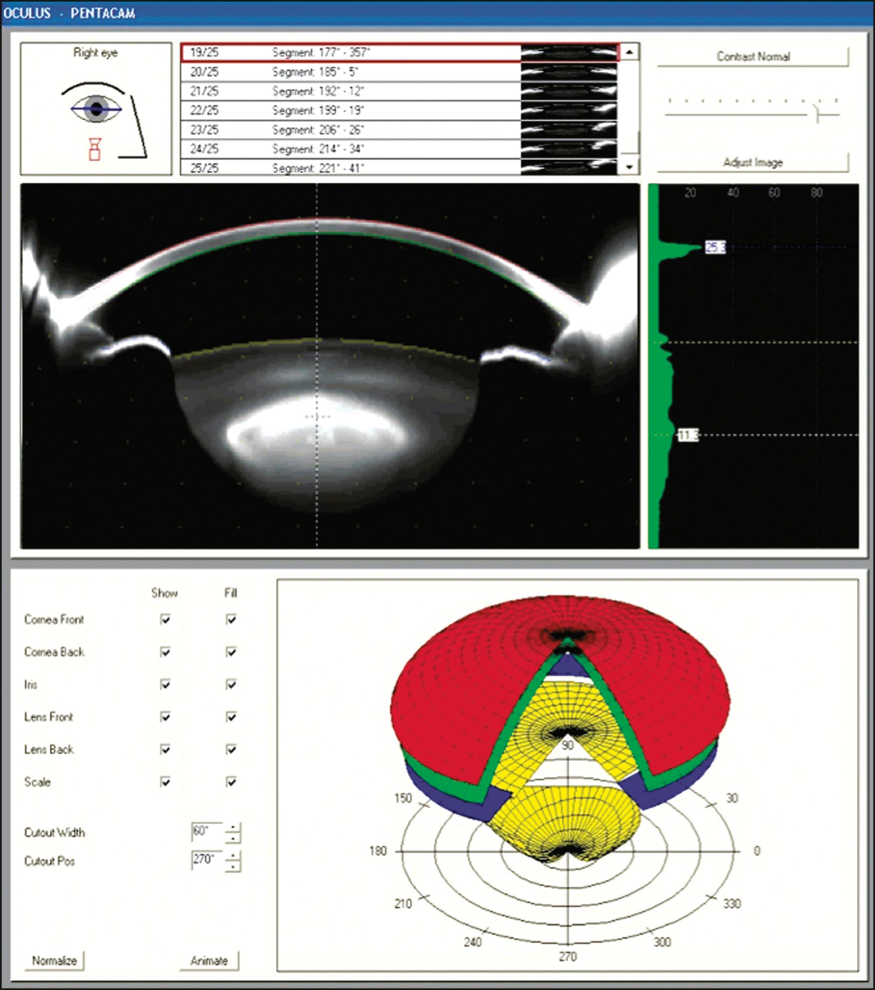 Fig. 11.5, Scheimpflug technology showing a cross-sectional image of the anterior segment with a three-dimensional surface representation.