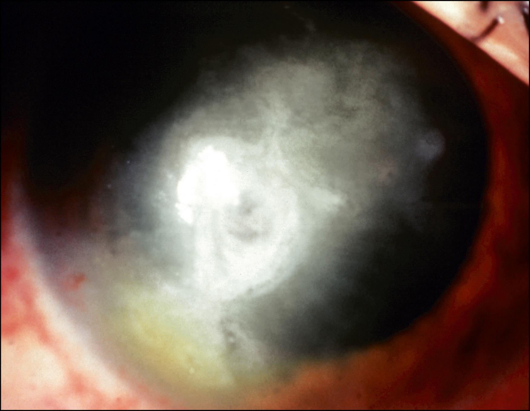 Fig. 125.2, Herpetic keratitis with stromal melting, thinning, and perforation. Structural support is necessary to reestablish integrity of the globe before surgery. Our option was the application of tissue adhesive (cyanoacrylate).