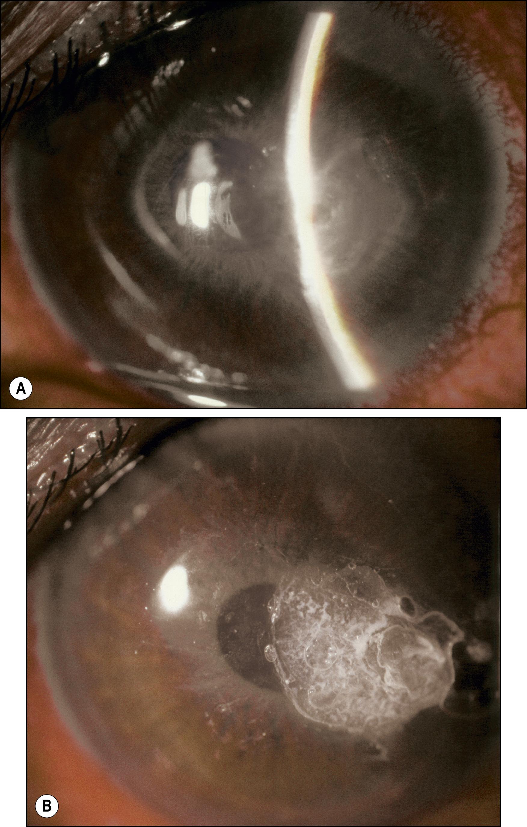 Fig. 125.3, Resolution of active inflammation at the time of the corneal graft is important. ( A ) This corneal perforation was managed with glue, and as soon as the eye was quiet ( B ), the patient underwent penetrating keratoplasty.