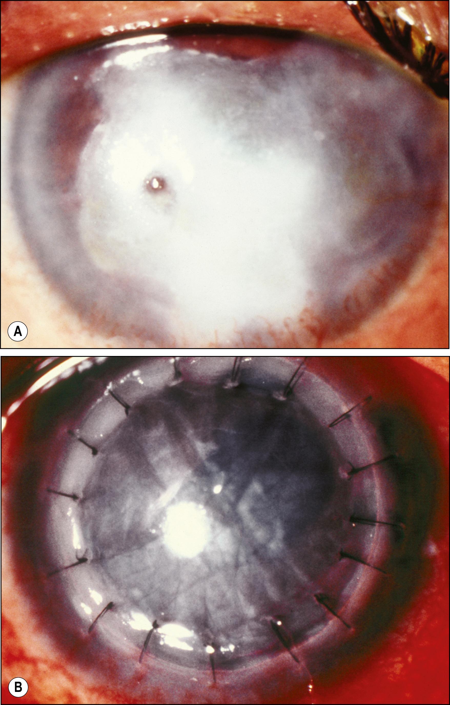 Fig. 125.4, Inflammation has been considered a risk factor for the survival of a clear cornea. ( A ) This patient underwent corneal grafting for a small perforation that could have been managed with glue. ( B ) The graft developed profound inflammation in the postoperative period with signs of graft failure.