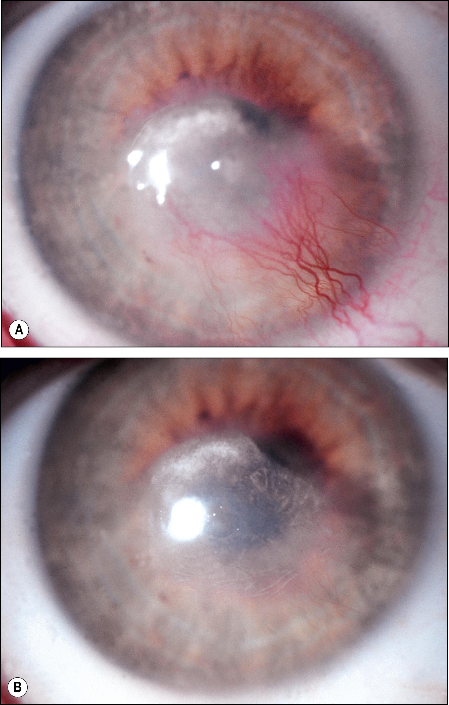 Fig. 125.5, Vascularization of the host cornea can decrease the chances for a clear graft. Deep stromal vascularization is more likely to be associated with rejection than is superficial vascularization. ( A ) This patient was treated with topical corticosteroids for stromal herpetic keratitis associated with neovascularization with complete closure of the vessels. ( B ) Chronic use of corticosteroids can cause cataract and glaucoma, requiring careful follow-up of those patients.