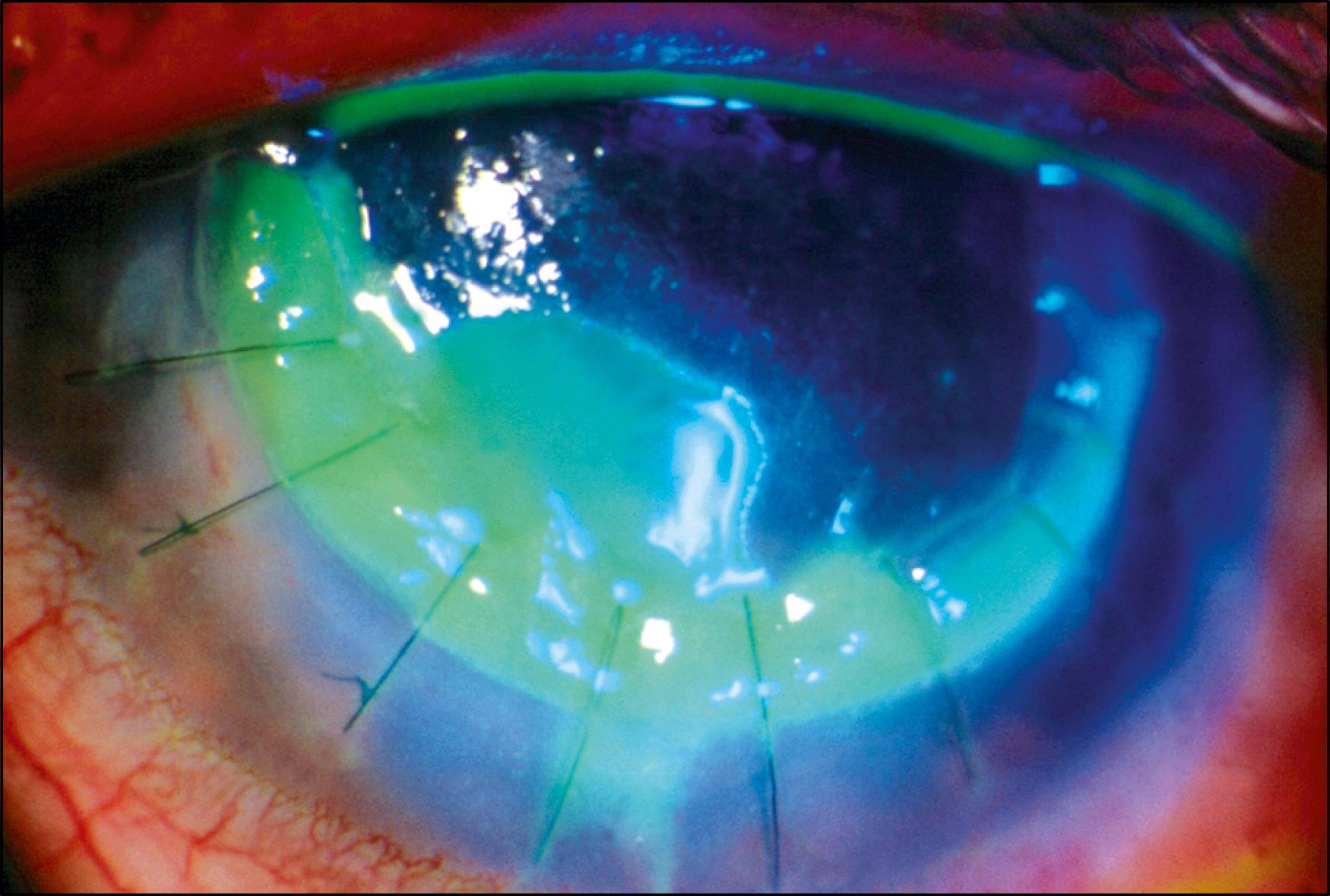 Fig. 125.6, Reduced corneal sensation may cause epithelial defects. It is important to check corneal sensation preoperatively.