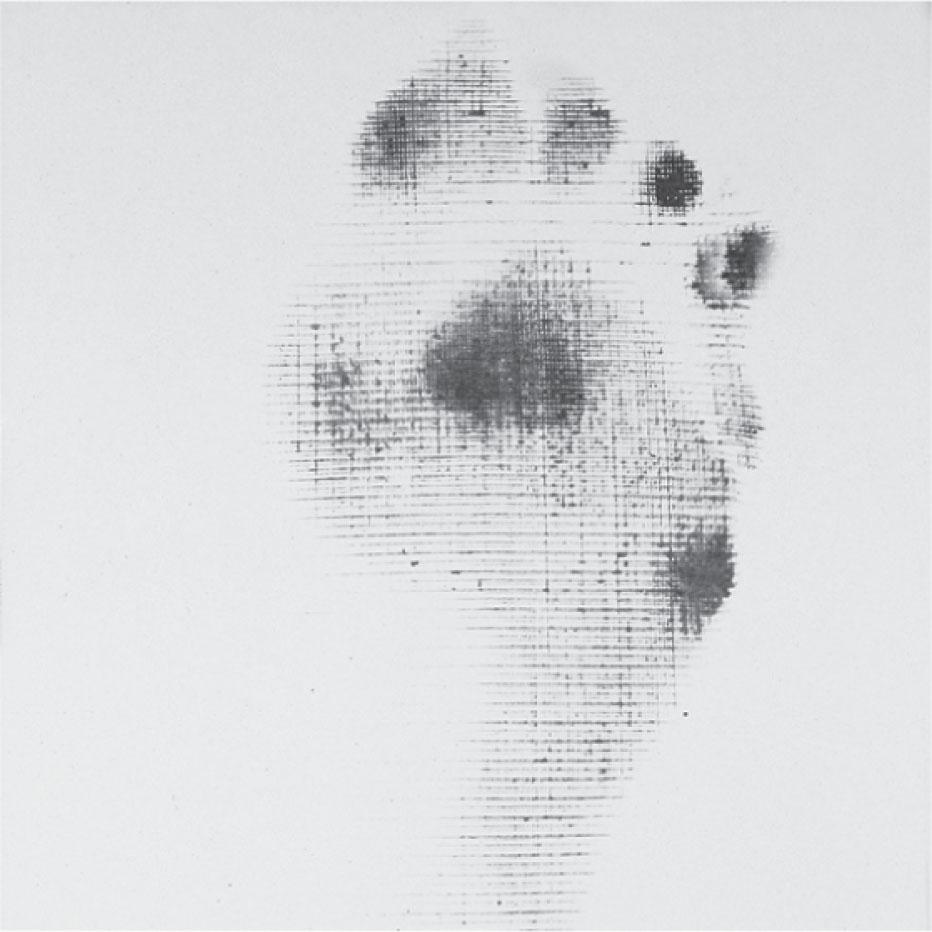 Fig. 13-2, Harris mat print of a patient with hypermobility of the first metatarsal. Because the first metatarsal does not carry much weight, pressure is transferred to the second and third metatarsals as well as to the tip of the hallux.