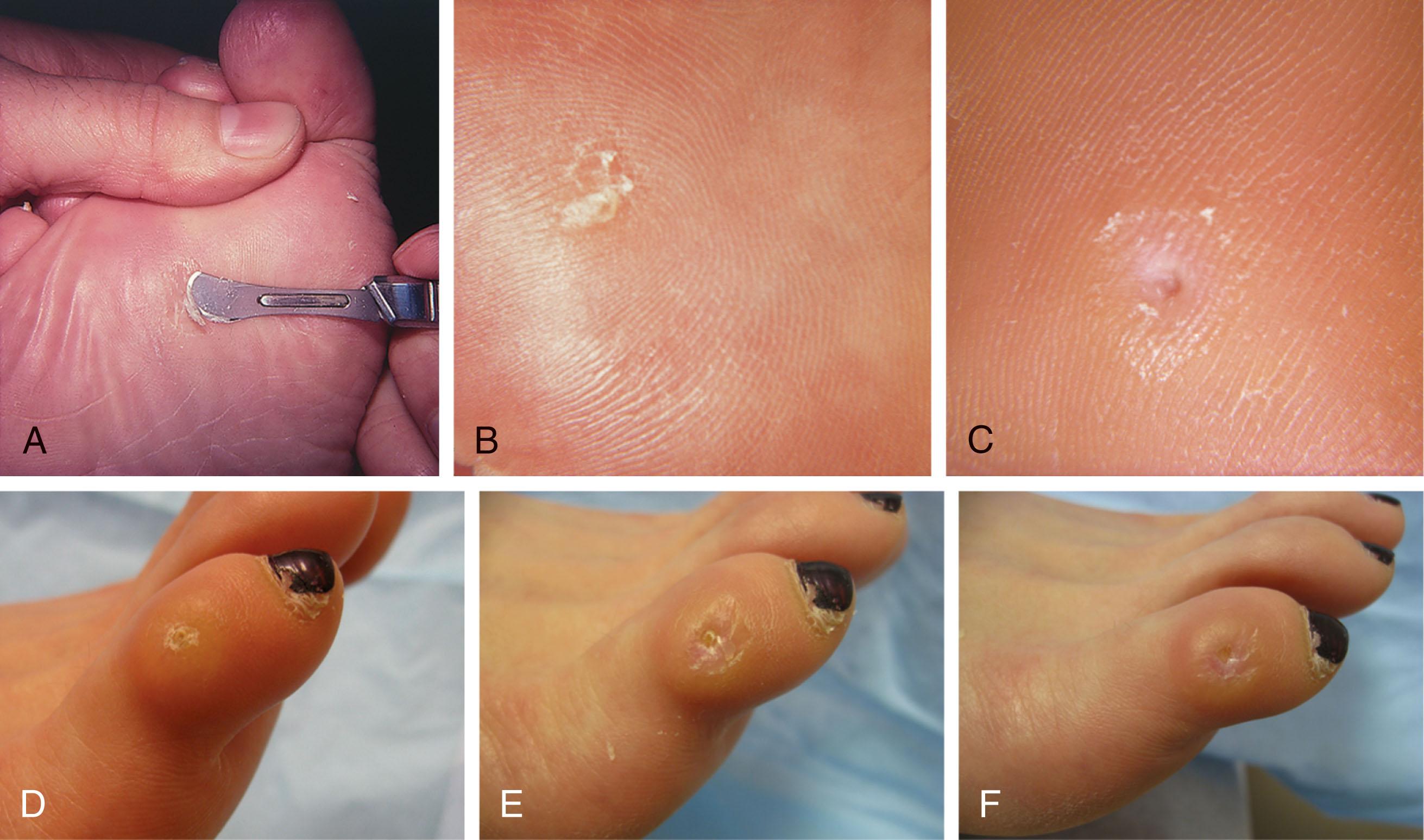 Fig. 13-12, A , Debridement of callus with No. 17 blade. B , A seed corn is a small keratotic lesion on the plantar aspect of the foot that at times becomes symptomatic. C , Appearance of seed corn after debridement. Keratotic lesion with seed corn on dorsum of fifth proximal interphalangeal (PIP) joint. D , Predebridement. E , Debridement of callus with seed corn remaining. F , After debridement of seed corn.