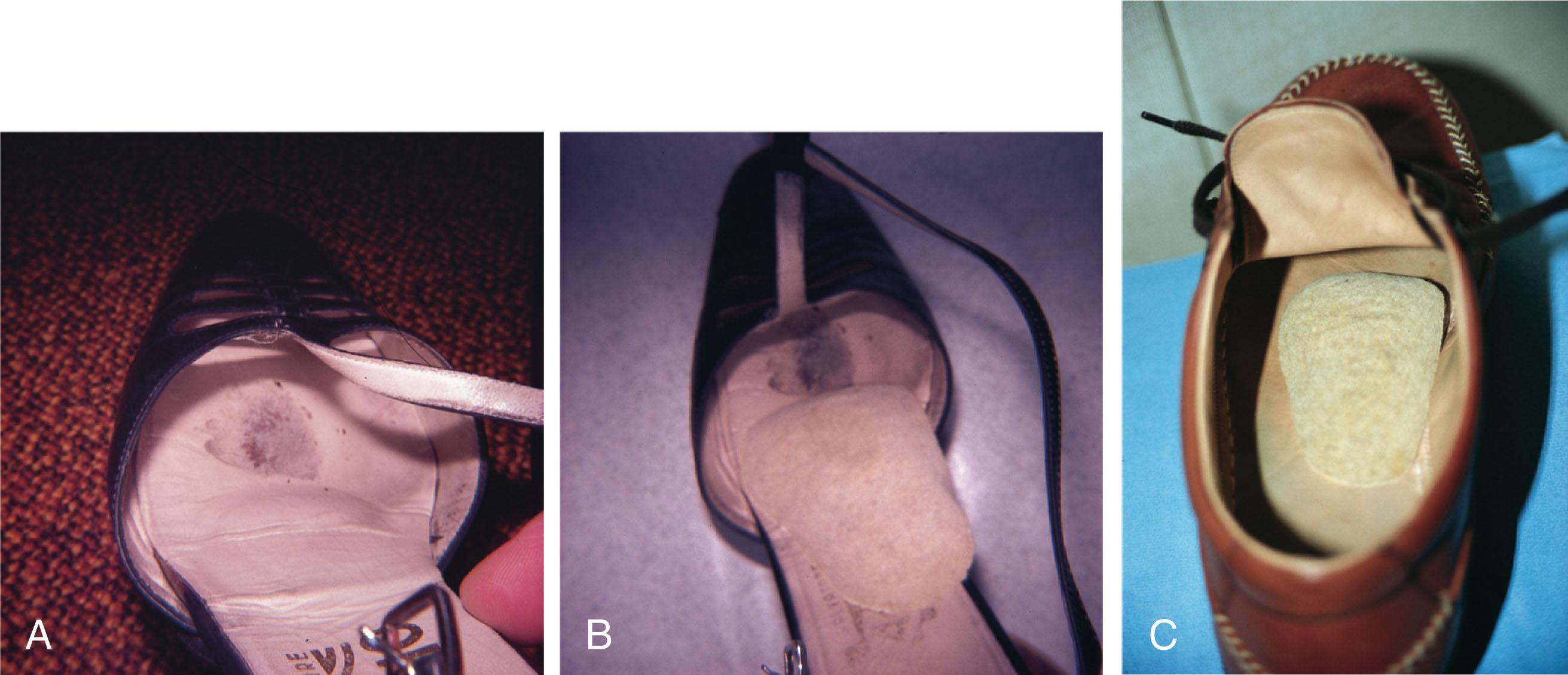 Fig. 13-14, Placement of a soft metatarsal support in the shoe. A , Support is placed just proximal to the “smudge” on the insole. This is usually around the base of the tongue. B and C , The support can be moved medially or laterally, depending on the location of the plantar lesion.