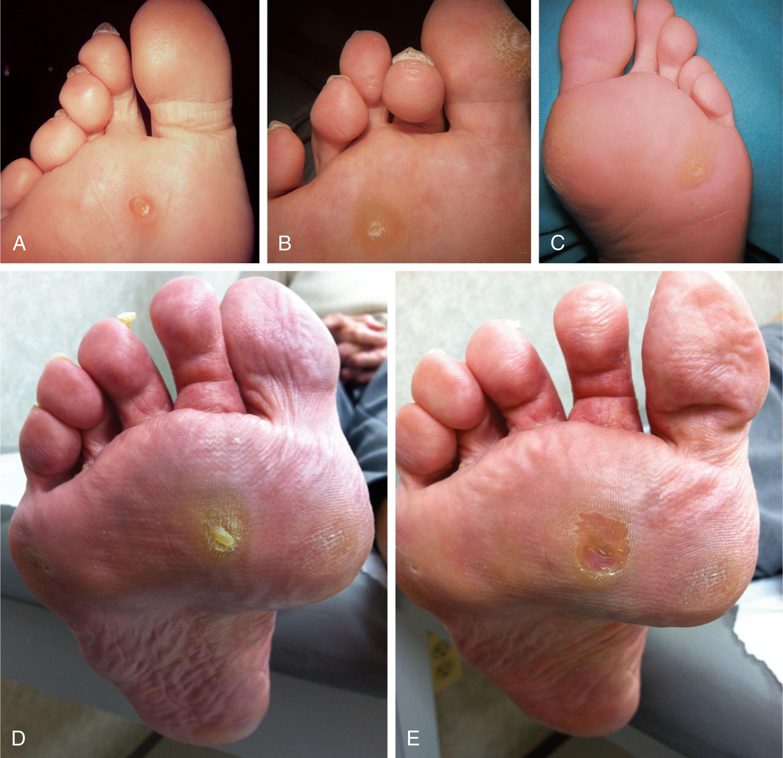 Fig. 13-15, Examples of discrete intractable plantar keratoses (IPKs). A , Lesion beneath the second metatarsal head. B , Discrete keratosis beneath the third metatarsal head. C , Discrete keratosis beneath the fourth metatarsal head. D , Discrete IPK under the second metatarsal head. E , Same patient as in D after shaving of the lesion with a blade.