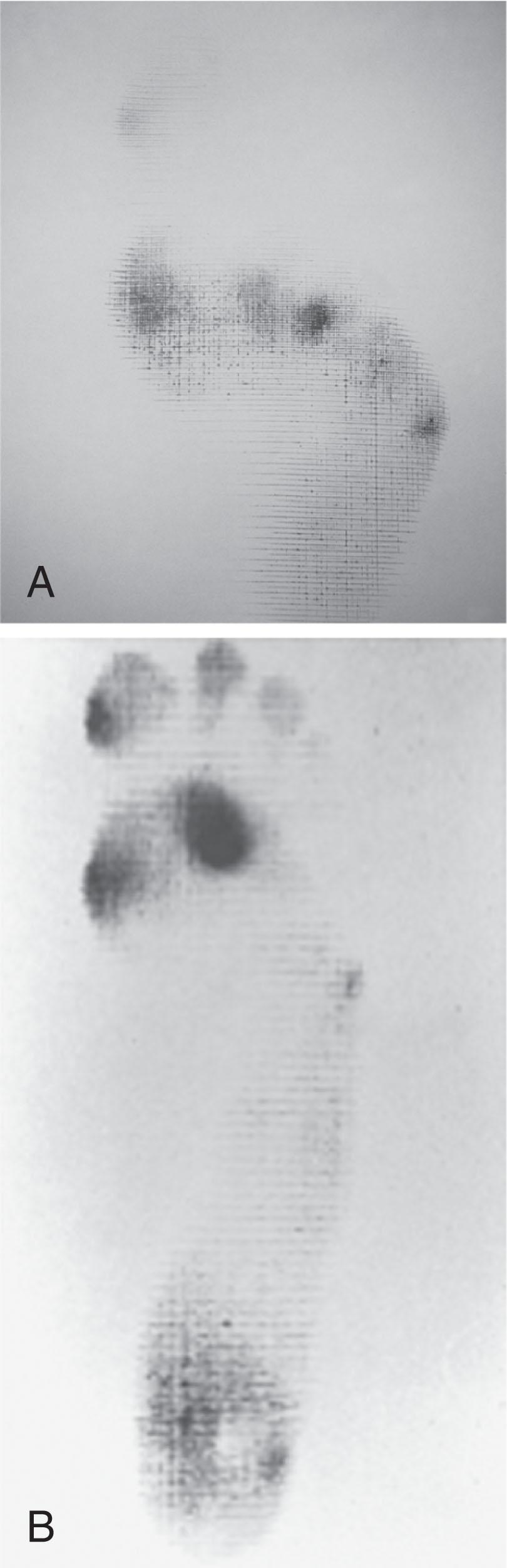 Fig. 13-16, Harris mat print comparing localized versus diffuse plantar keratoses. A , Imprint demonstrating well-localized area of pressure—a discrete plantar keratosis. B , Imprint demonstrates diffuse keratotic lesion beneath second metatarsal head.