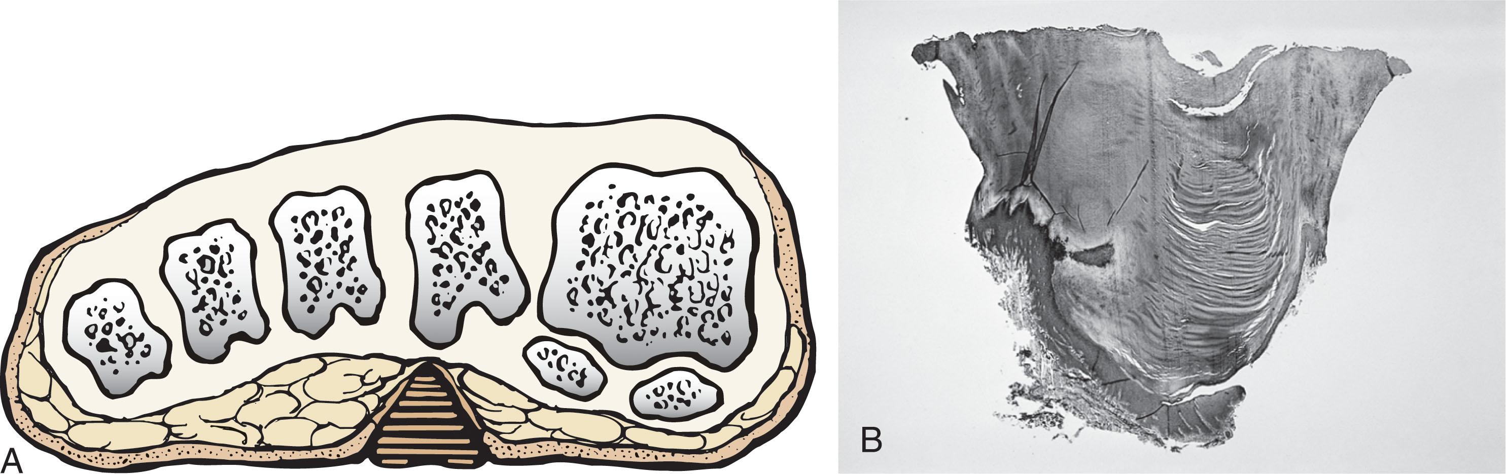 Fig. 13-17, A , Location of a discrete plantar keratosis beneath a prominent fibular condyle. B , Histologic features of the keratotic lesion demonstrate layers of keratin with no blood vessels. Compare with Fig. 13-10B.